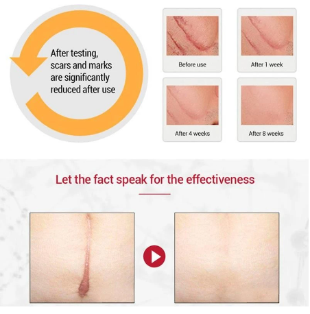 ACNE SCAR REMOVAL CREAM
