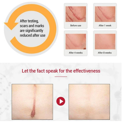ACNE SCAR REMOVAL CREAM